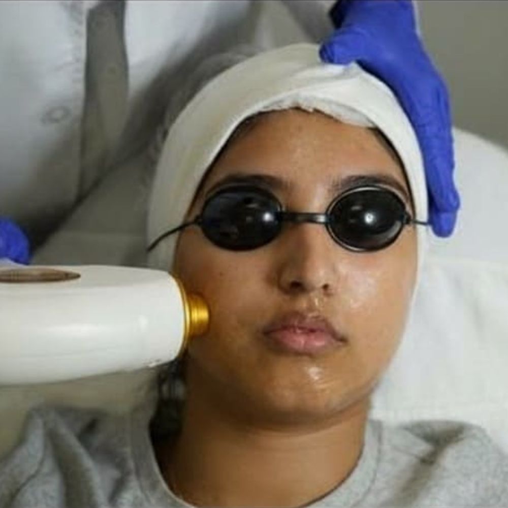 Sideburn Laser Hair Removal