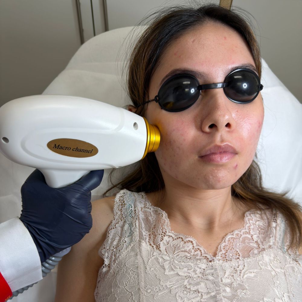 Sideburn Laser Hair Removal